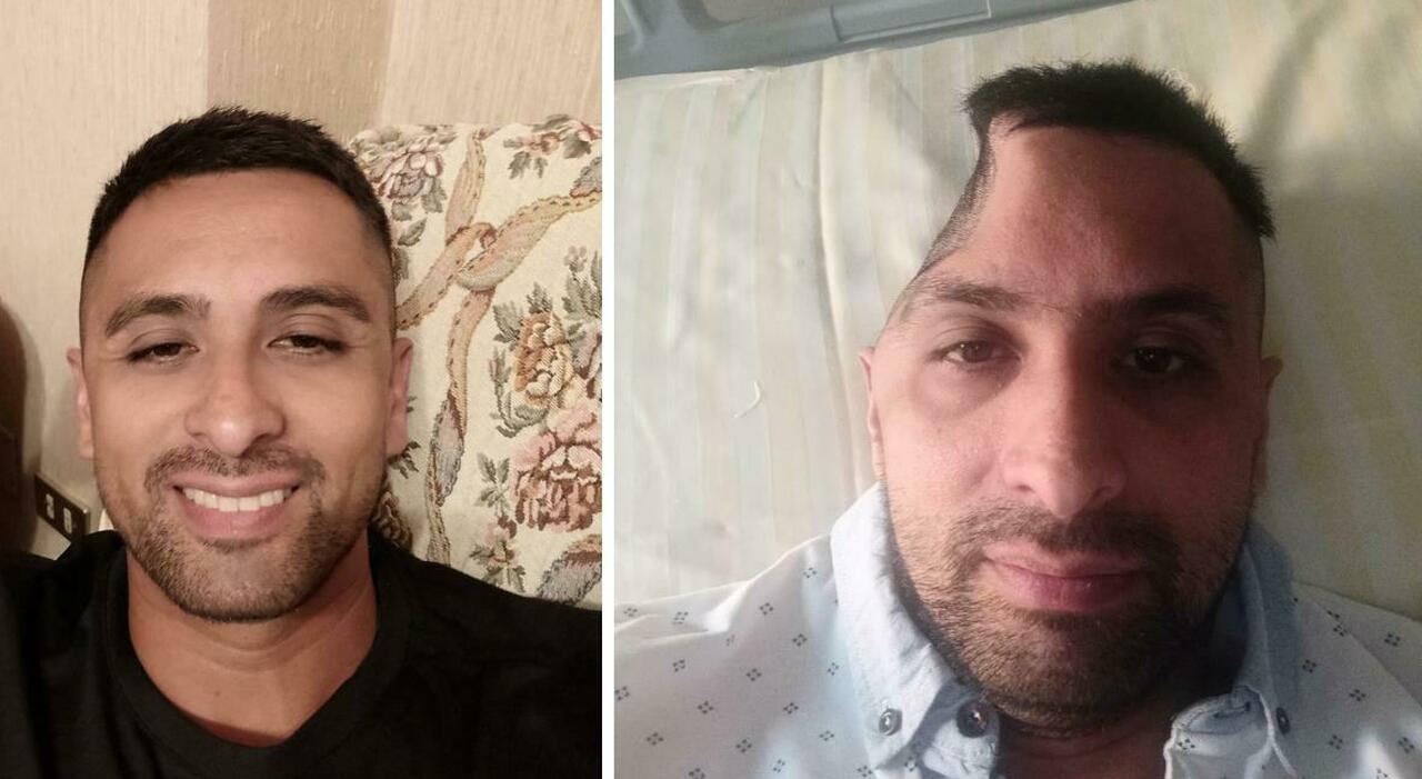 Travolto mentre va in bici, gli tolgono un pezzo di cranio. La storia assurda di Carlo Perticarini: «Nessuno mi risarcisce» Travolto mentre va in bici, gli tolgono un pezzo di cranio. La storia assurda di Carlo Perticarini: «Nessuno mi risarcisce»