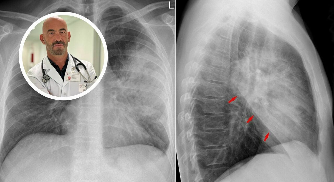 polmonite boom di casi matteo bassetti ospedali gi224 pieni sintomi cause cure e cosa non fare da Leggo.it polmonite boom di casi matteo bassetti ospedali gi224 pieni sintomi cause cure e cosa non fare