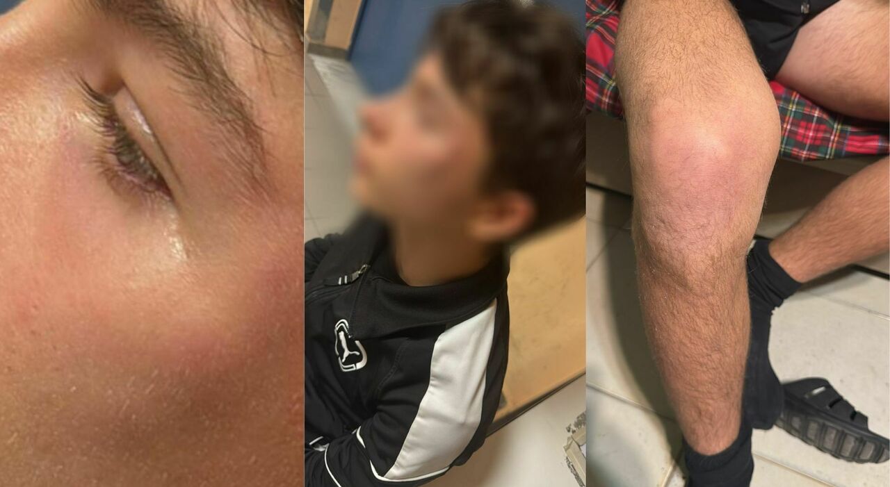 Arbitro 15enne aggredito in Puglia: stava dirigendo una partita di coetanei, poi le botte. L Arbitro 15enne aggredito in Puglia: stava dirigendo una partita di coetanei, poi le botte. L