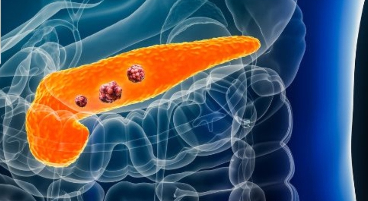 Tumore pancreas: i 5 sintomi, l
