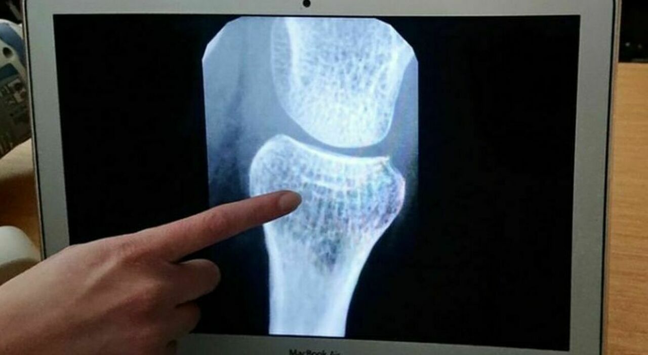 https://statics.cedscdn.it/photos/MED_HIGH/2026/05/17/9537627_17083329_osteoporosi_donne_rischi_morte_prematura_prevenzione.jpg