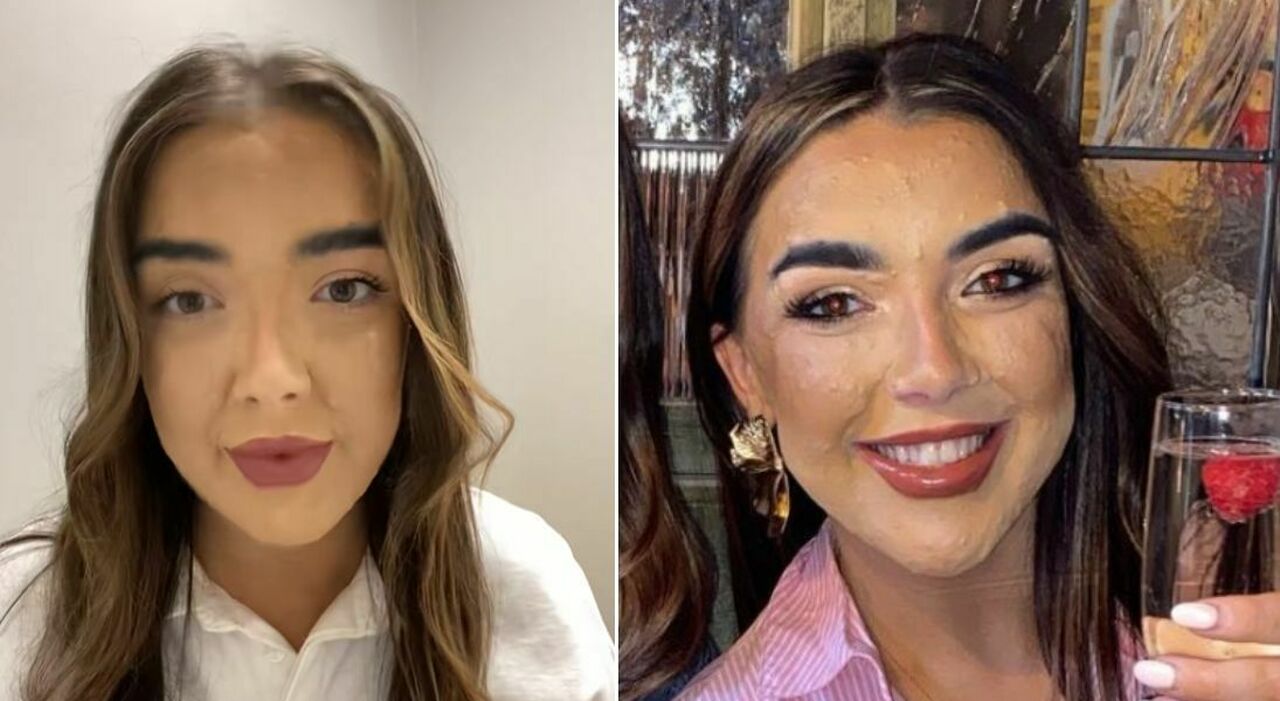 Laura Kelly: Overcoming Rare Skin Condition and Finding Self-Acceptance - News Directory 3