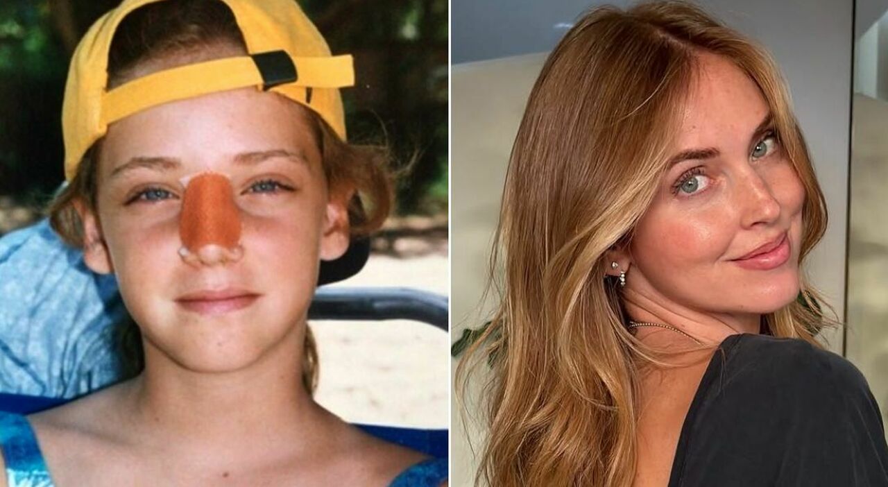 https://statics.cedscdn.it/photos/MED_HIGH/2026/09/09/9753327_09163610_chiara_ferragni_naso_storto_operazione_foto.jpg