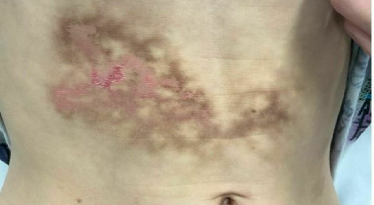 https://statics.cedscdn.it/photos/MED_HIGH/2026/09/11/9757286_11125155_sindrome_della_pelle_tostata_eritema_ab_igne_portatile_laptop.jpg