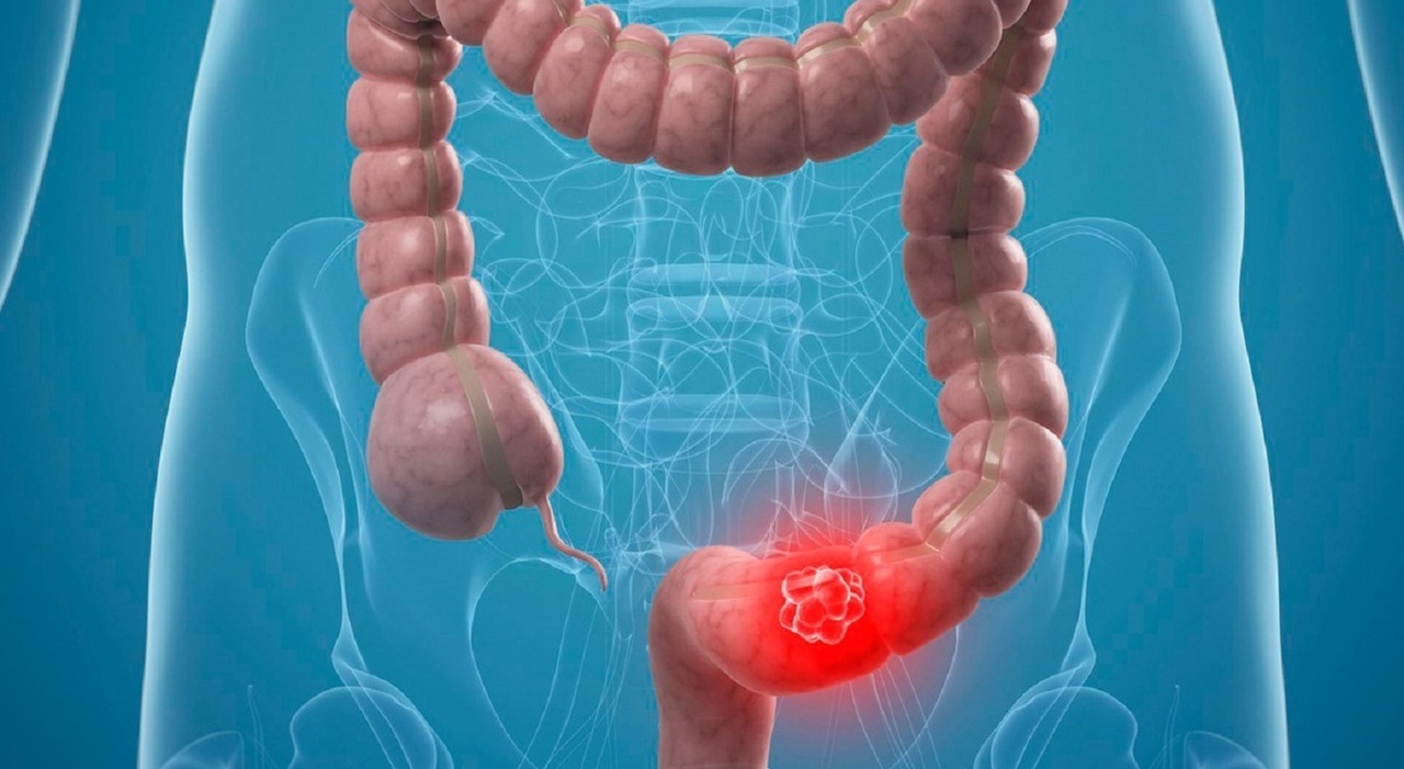 Tumore al colon, la malattia di Matteo Messina Denaro: con metastasi è fra  i più letali