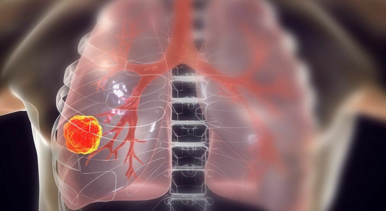 Lung cancer, the algorithm capable of predicting cancer years earlier ...