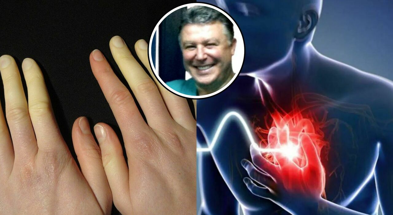 Freddo e infarti, il sintomo delle mani. Il cardiologo: «Ecco come riconoscere la sindrome di Raynaud»