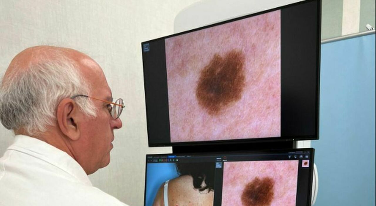 Melanoma così 