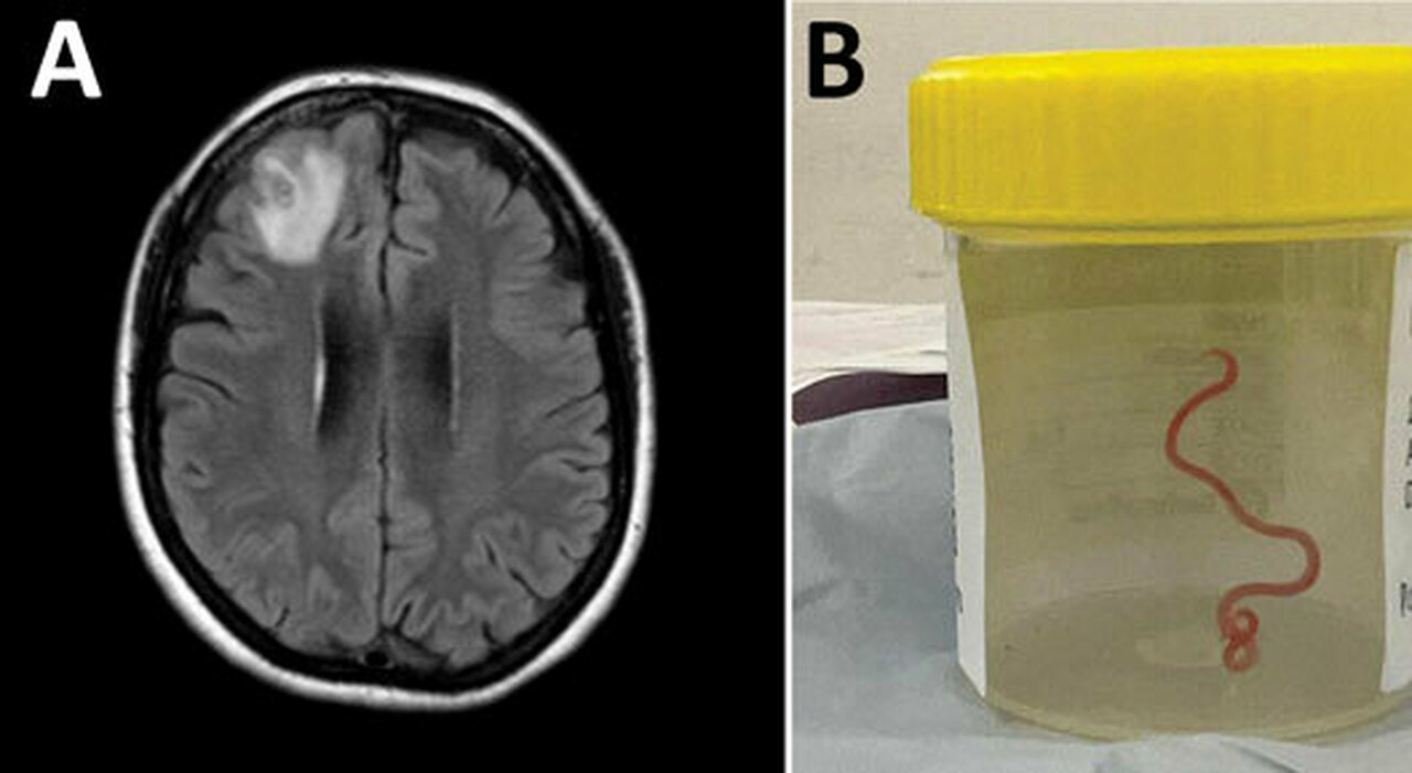 Live larva inside the brain of a 64-year-old Australian patient rescued in Canberra: World’s first case
