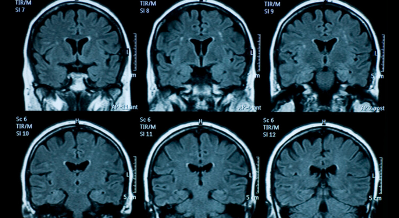 Alzheimer’s and Parkinson’s caused by head trauma? They can awaken “sleeping” viruses in the brain. Hypothesis drugs to stop them