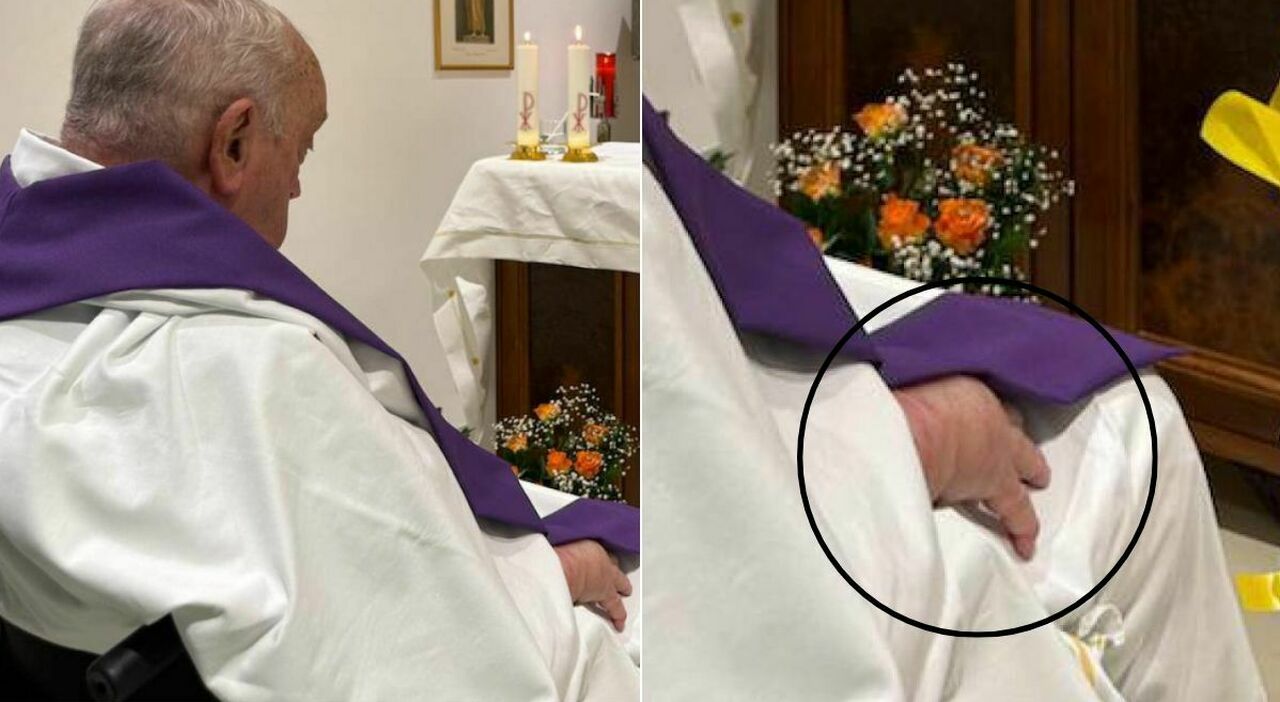 Papa Francesco e la mano gonfia nella foto, «forse un accumulo di liquidi»: cosa significa e quando potrà essere dimesso