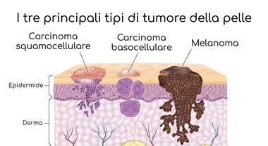 Dalla padella alla brace, svapare da giovani pu portare a fumare le sigarette vere Dalla padella alla brace, svapare da giovani pu portare a fumare le sigarette vere