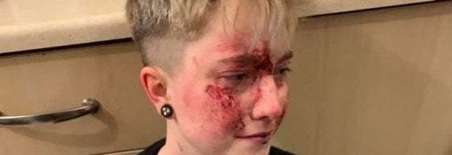 Ventenne aggredita cinque volte perché è lesbica: «Ecco le foto delle mie ferite»