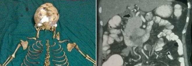 Vive per 36 anni con lo scheletro del suo bimbo
mai nato nella pancia: "Incinta nel 1978"