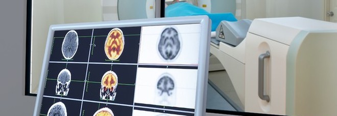 Ragazza nata con metà cervello ha un'intelligenza sopra la media Ragazza nata con metà cervello ha un'intelligenza sopra la media