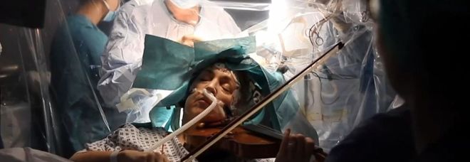 Tumore al cervello, suona il violino mentre la operano: la straordinaria scelta della musicista inglese