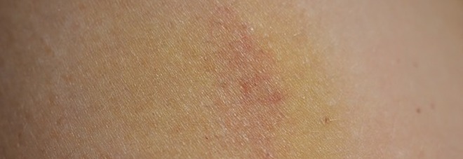 Lividi sulla pelle all'improvviso? Ecco perché vengono facilmente