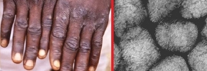 Vaiolo delle scimmie, l'allerta del virologo: «Malattia grave, morte in un paziente su 5»