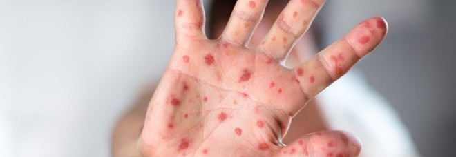Morbillo, nel 2018 record di casi in Europa: 41.000. Italia tra i sette Paesi peggiori Morbillo, nel 2018 record di casi in Europa: 41.000. Italia tra i sette Paesi peggiori