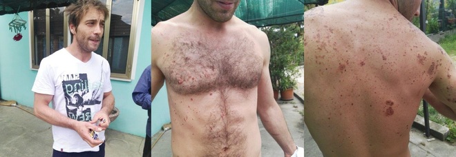 «Colpito dagli schizzi di metallo fuso E i vestiti ignifughi sono stati inutili» /Foto