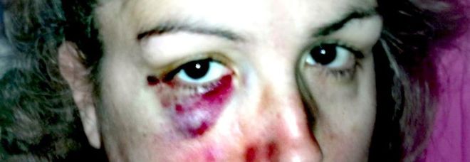 La consigliera comunale pubblica la sua foto con occhio nero e labbro sanguinante: «Donne, denunciate»