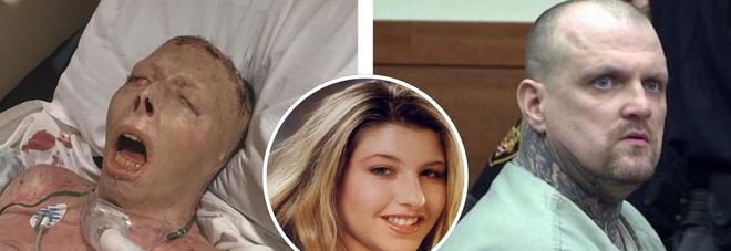 Bruciata viva dal fidanzato, Judy testimonierà contro di lui anche da morta Bruciata viva dal fidanzato, Judy testimonierà contro di lui anche da morta