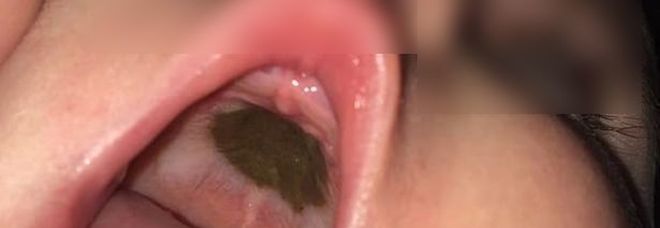 Bimba ha una strana macchia
sul palato, i medici non sanno
cos'è. Poi la scoperta...