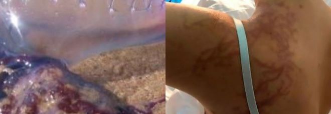 Medusa Man O'War attacca
7 bagnanti: feriti e ricoverati
in ospedale, terrore in spiaggia
