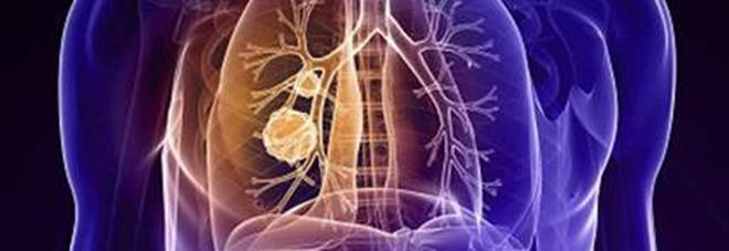 «Tumori sconfitti entro il 2050 con l'immunoterapia». L'annuncio del Nobel della Medicina Honjo «Tumori sconfitti entro il 2050 con l'immunoterapia». L'annuncio del Nobel della Medicina Honjo