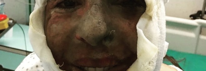 Gessica Notaro, la prima foto dopo l'aggressione con l'acido: Gessica Notaro, la prima foto dopo l'aggressione con l'acido:
