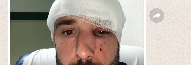 Portiere steso in campo con un pugno dall'avversario: naso fratturato
