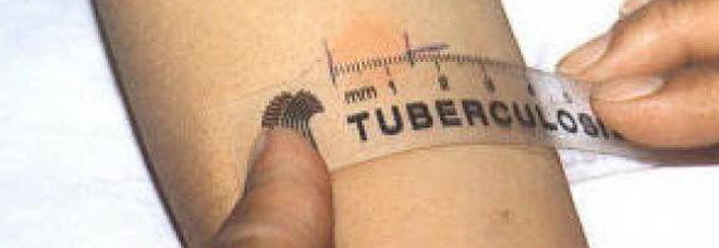 Tubercolosi a scuola, la Ulss2 decide test di massa per tutti: 400 coinvolti Tubercolosi a scuola, la Ulss2 decide test di massa per tutti: 400 coinvolti