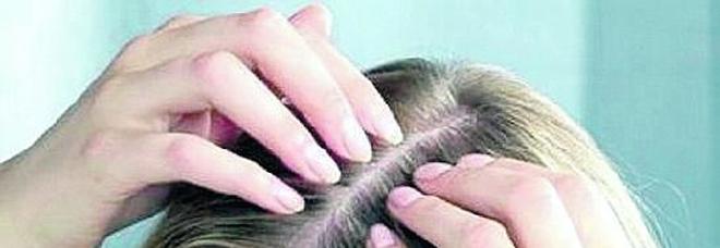 Calvizia femminile come si vince