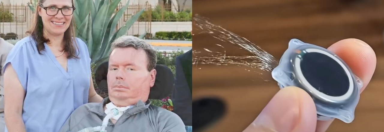 Malato di Sla torna a parlare grazie a Neuralink: Brad Smith ha registrato  un video con il pesiero usando il chip di Elon Musk