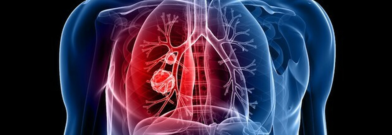 Cancro al polmone, la scoperta: «In chi non ha mai fumato mutazioni diverse dai fumatori»