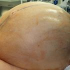Rimosso un tumore ovarico di 60 kg: operazione da record negli Usa