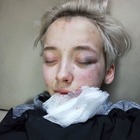 Ragazza lesbica di 18 anni aggredita da 7 uomini perché omosessuale. Le foto choc in rete