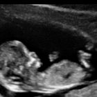 Anche in Kentucky le donne prima di abortire sono obbligate ad ascoltare il battito cardiaco del feto