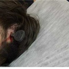 Rissa al campo di calcio, 12enne arriva in ospedale con una chiave infilzata in testa FOTO