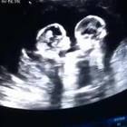 Gemelline fanno a pugni nell'utero della mamma: l'ecografia diventa virale