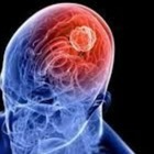 Emorragia cerebrale: cos'è, che sintomi ha e quando si può morire con la malattia che ucciso Frizzi