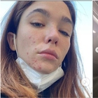 Matilda De Angelis, l'ansia, la sofferenza e l'acne. Lo sfogo su Instagram: «Imparate a chiedere aiuto»