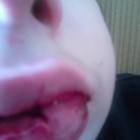 Rovigo, bimbo disabile picchiato a scuola dai bulli: la mamma pubblica le foto choc
