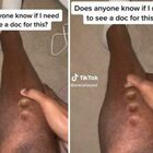 La pelle si trasforma in gomma, scopre di essere gravemente malato grazie al video TikTok