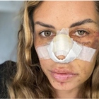 Carlotta Adacher, la foto choc dopo l'incidente: «Temevo di non poter più riaprire gli occhi»