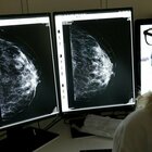 Tumore al seno, nuovo anticorpo monoclonale più efficace della chemio: riduce il rischio di morte del 36%