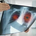 Tumore ai polmoni, un bando da 100mila euro