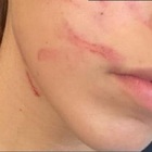 Ragazzina di 13 anni picchiata dai compagni di classe, il papà condivide la foto choc: «Pensavo che la scuola fosse sicura»