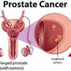 Cancro prostata metastatico resistente, terapia migliora sopravvivenza