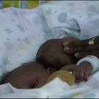 Bambino Gesù, separate le due gemelline siamesi arrivate dal Burundi